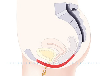 Pelvic-Floor Muscle Repair 5 Pelvic floor muscles Maidenhead